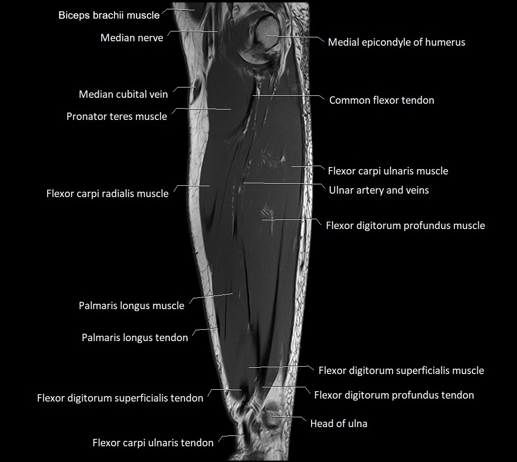 MRI 3T forearm sagittal labelled cross sectional anatomy image 29.webp